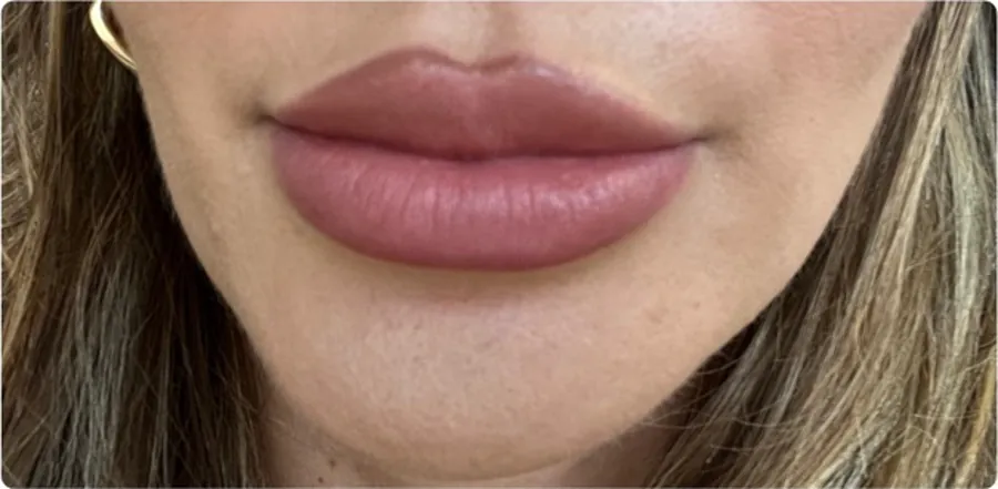 Lips before and after dermal filler — after