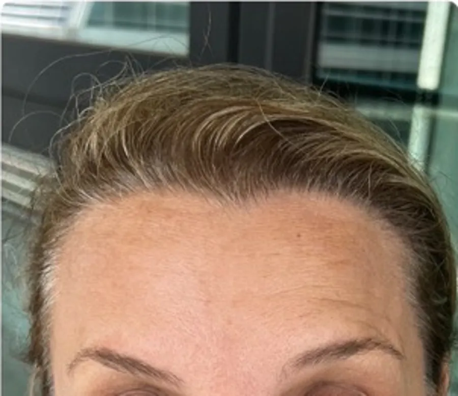 Forehead lines before and after Botox treatment — after