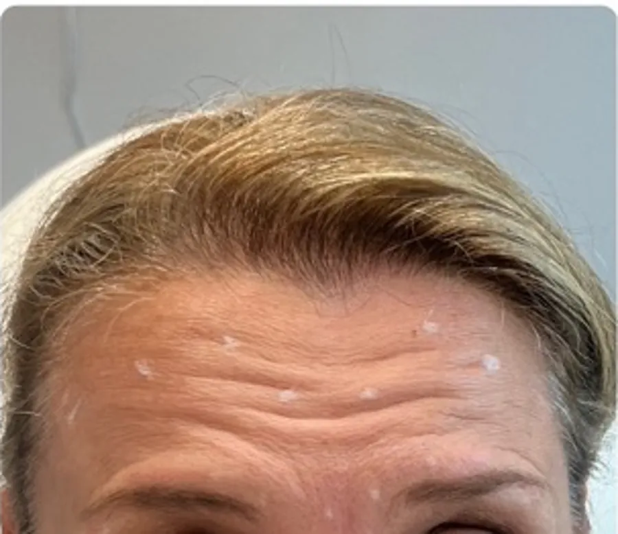 Forehead lines before and after Botox treatment — before