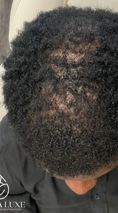 Top of the scalp with thinning at the part line before, and denser coverage after, hair restoration — after