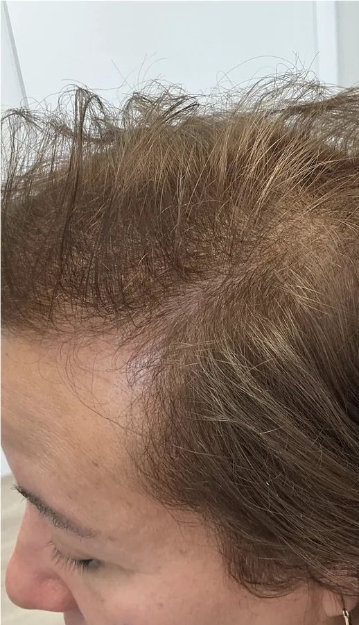 Receding temple before and regrowth along the hairline after hair restoration — after