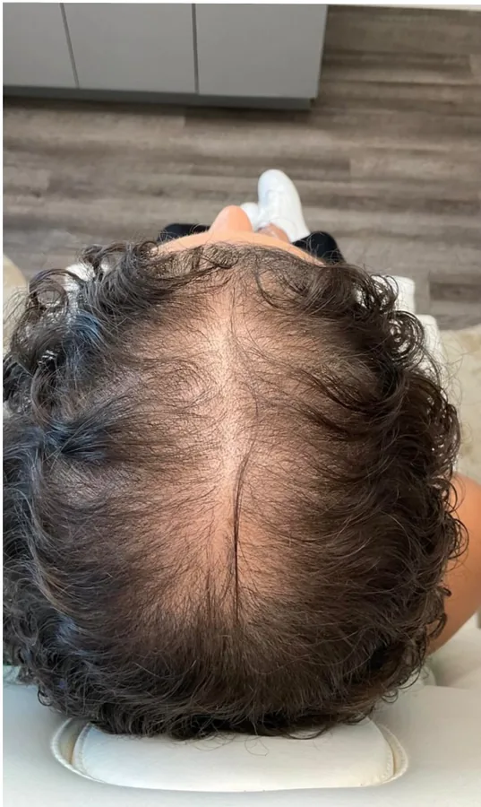 Wide part line before and narrower part after hair restoration — before