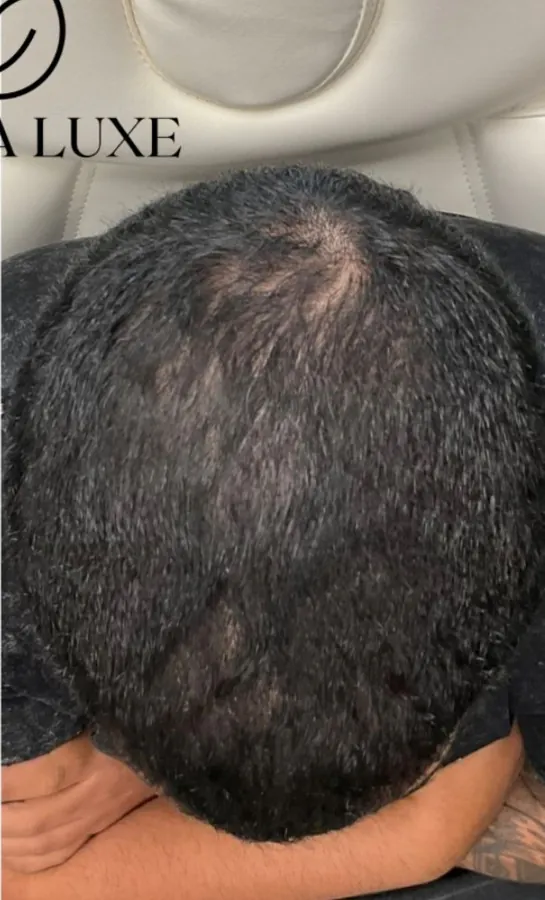Crown of the scalp before and after hair restoration, photographed from above — after