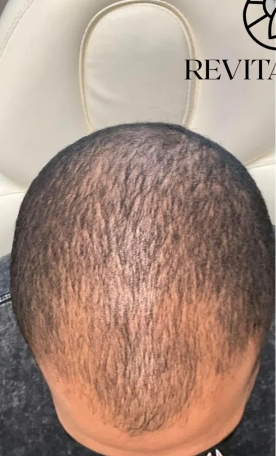 Crown of the scalp before and after hair restoration, photographed from above — before
