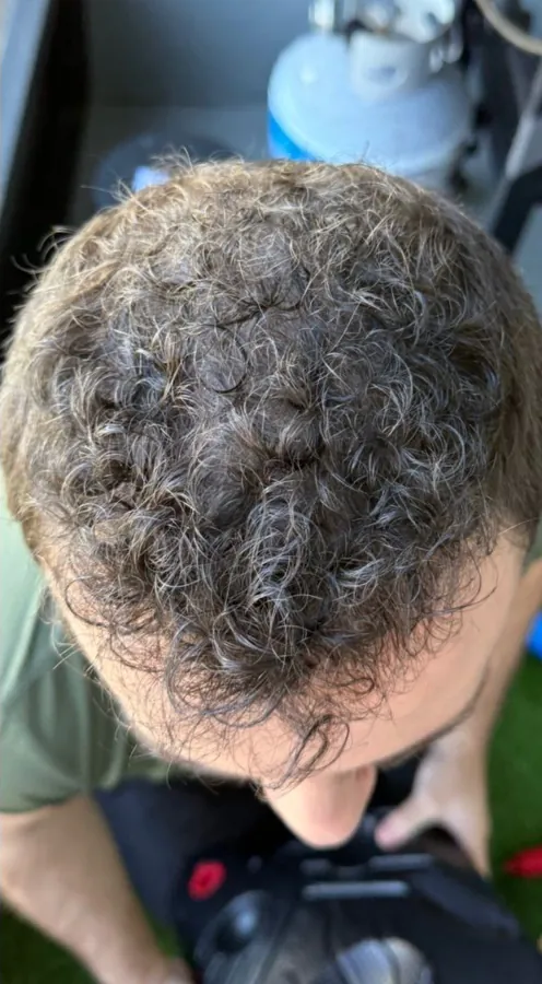 Receding hairline before and thicker frontal hair after hair restoration — after