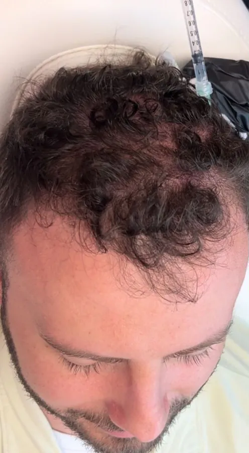 Receding hairline before and thicker frontal hair after hair restoration — before