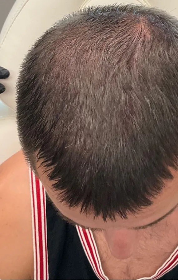 Thinning crown before and fuller crown after hair restoration — after