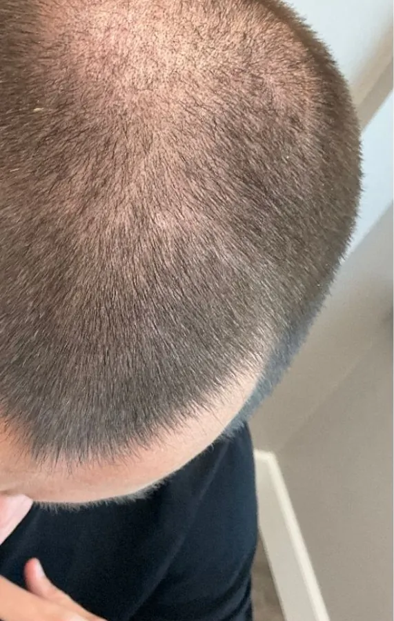 Thinning crown before and fuller crown after hair restoration — before