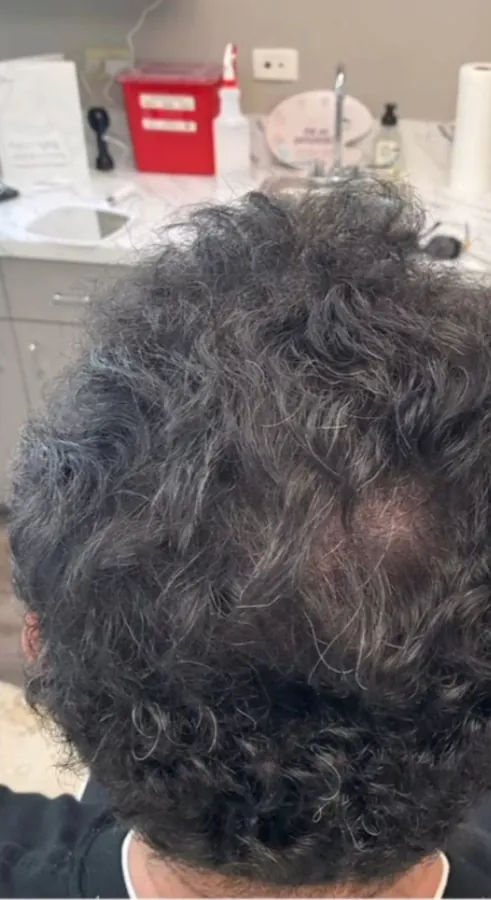Curly hair at the crown before and after hair restoration — after