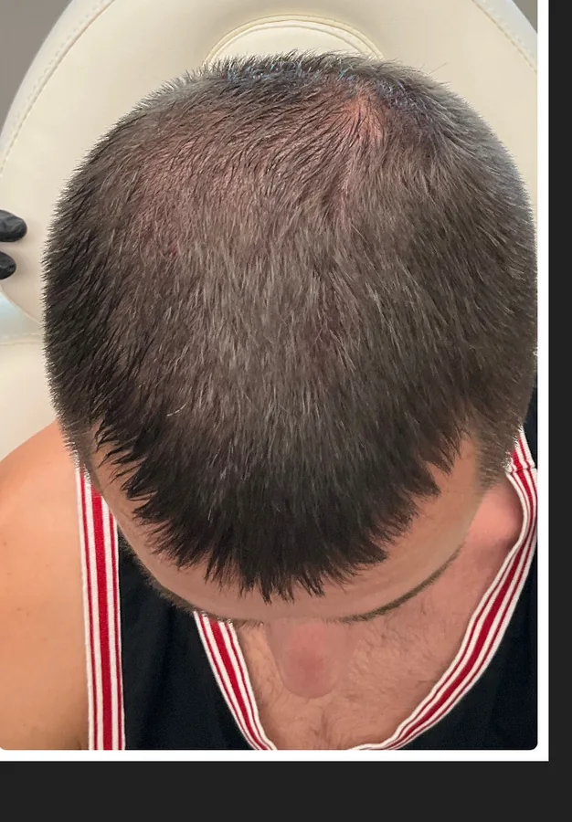 Thinning crown and front before, and thicker coverage after, hair restoration — after