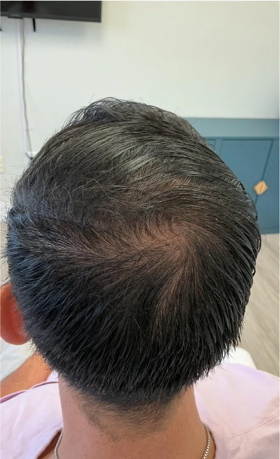 Thinning crown before and denser crown after hair restoration — after