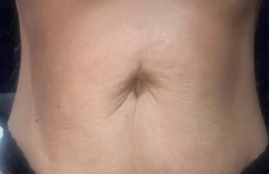 Loose, creased skin across the abdomen before, and smoother, tighter skin after, T-Shape 2 body contouring — after