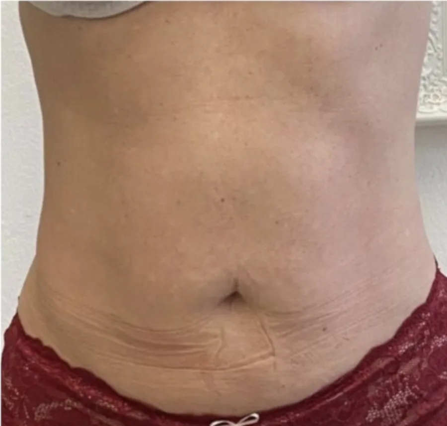 Lax skin below the navel before, and a flatter, smoother abdomen after, T-Shape 2 body contouring — after