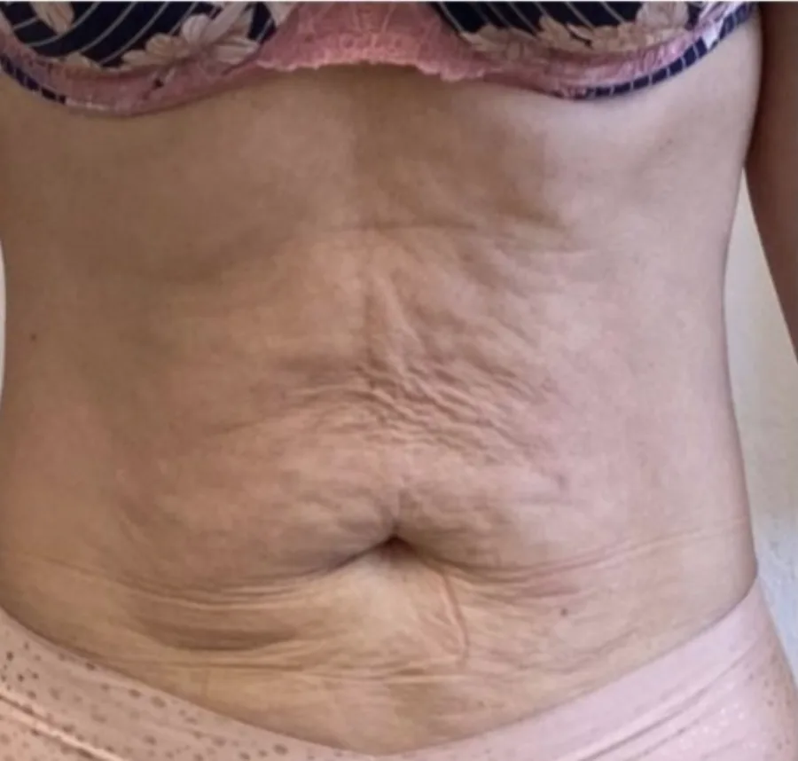 Lax skin below the navel before, and a flatter, smoother abdomen after, T-Shape 2 body contouring — before