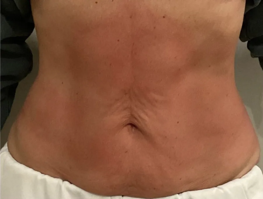 Creased, loose skin across the lower back before, and firmer, smoother skin after, T-Shape 2 body contouring — after