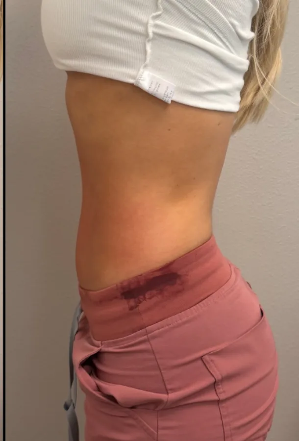 Side profile of the waist before, and a slimmer, more defined waistline after, T-Shape 2 body contouring — after
