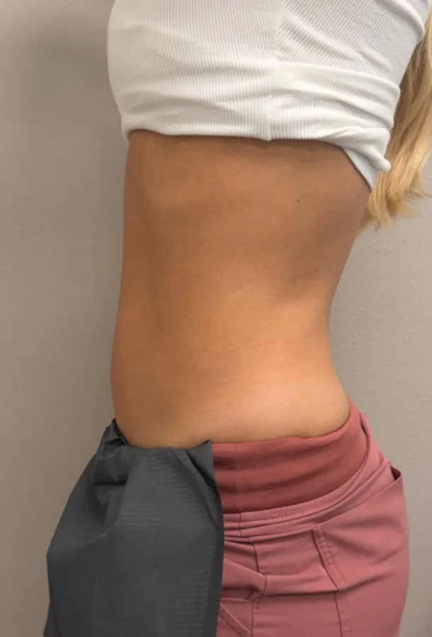 Side profile of the waist before, and a slimmer, more defined waistline after, T-Shape 2 body contouring — before